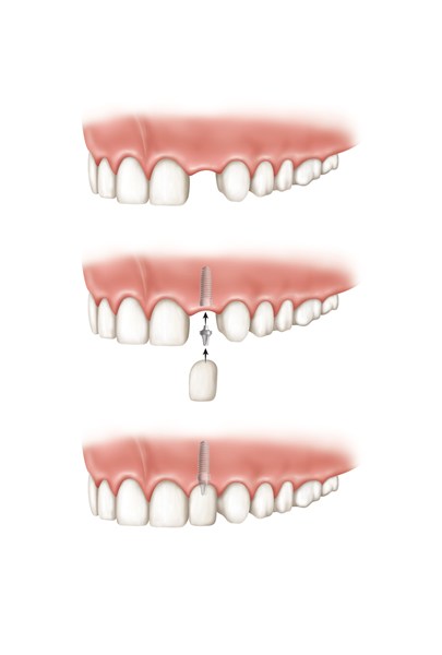 Implantes dentários de um dente