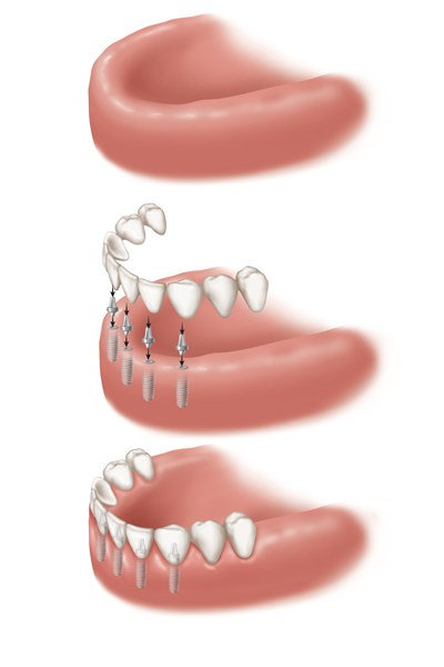 Implantes dentários de vários dentes