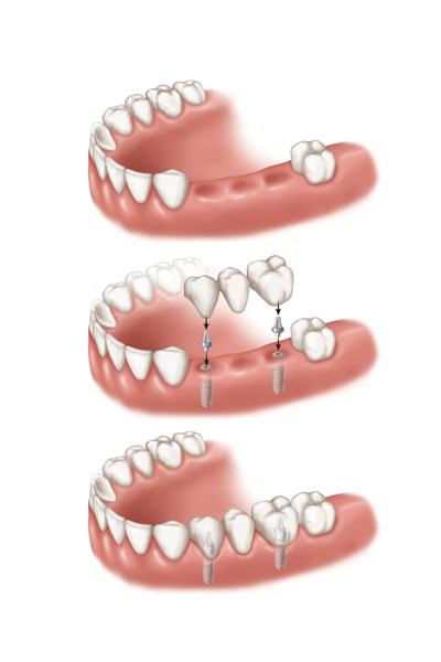 Implantes dentários de vários dentes