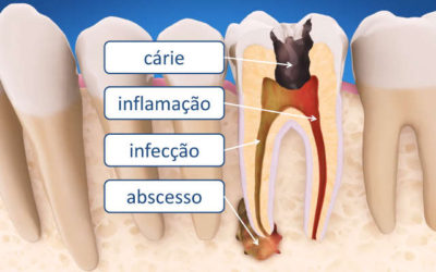 Tratamento de Canal de Dente: Perguntas e Respostas - MSK Odontologia