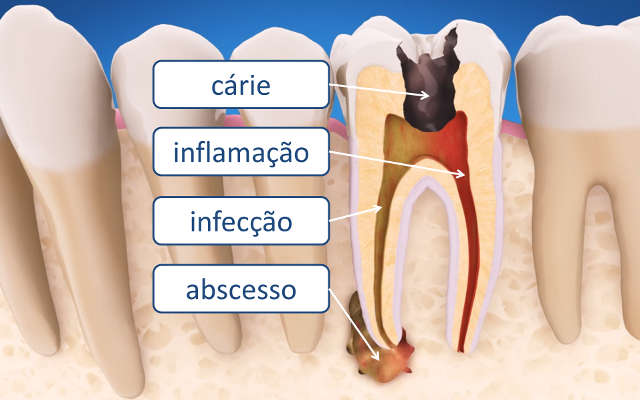 tratamento de canal dentário