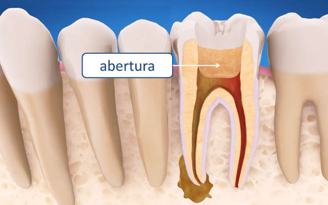 como é feito canal no dente