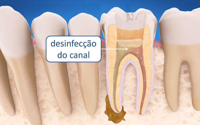 como é feito canal no dente