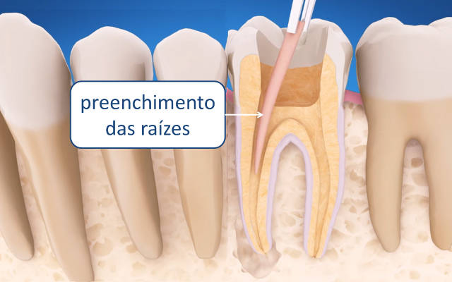 tratamento de canal dentário