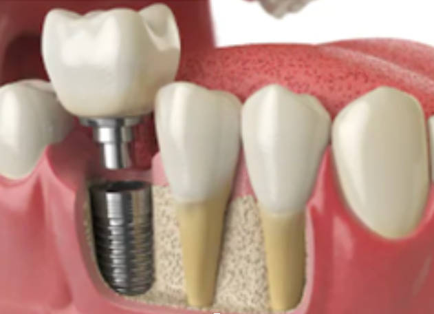 Implantes dentários de um dente