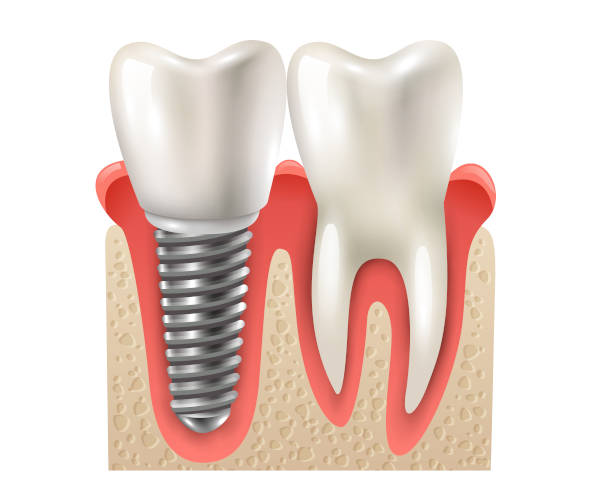 Tomografia para implante dentário